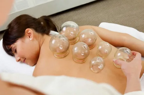Cupping Therapy mebourne
